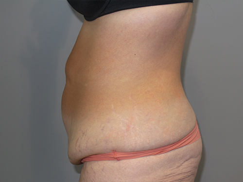 Tummy Tuck Before and After 101 | Sanjay Grover MD FACS