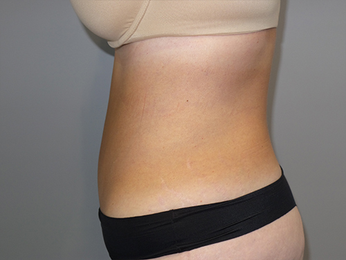Tummy Tuck Before and After 101 | Grover Aesthetics