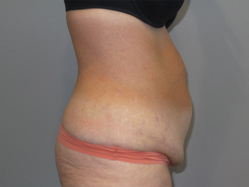 Tummy Tuck Before and After 101 | Sanjay Grover MD FACS