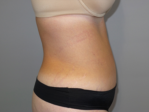 Tummy Tuck Before and After 101 | Grover Aesthetics