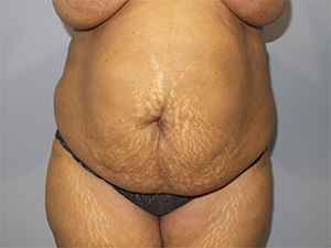 Tummy Tuck Before and After 81 | Sanjay Grover MD FACS