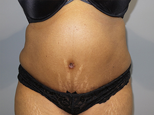 Tummy Tuck Before and After | Grover Aesthetics