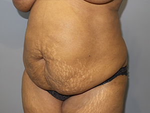 Tummy Tuck Before and After 102 | Sanjay Grover MD FACS