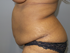 Tummy Tuck Before and After 102 | Sanjay Grover MD FACS