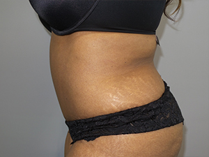 Tummy Tuck Before and After 102 | Sanjay Grover MD FACS