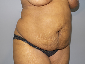 Tummy Tuck Before and After 102 | Sanjay Grover MD FACS