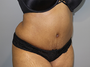 Tummy Tuck Before and After 102 | Sanjay Grover MD FACS