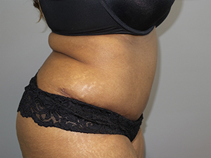 Tummy Tuck Before and After 102 | Sanjay Grover MD FACS