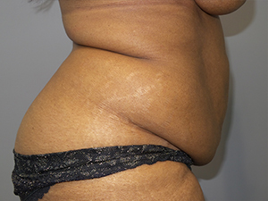 Tummy Tuck Before and After 102 | Sanjay Grover MD FACS