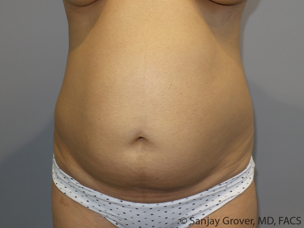 Tummy Tuck Before and After 59 | Sanjay Grover MD FACS