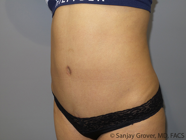 Tummy Tuck Before and After 103 | Sanjay Grover MD FACS