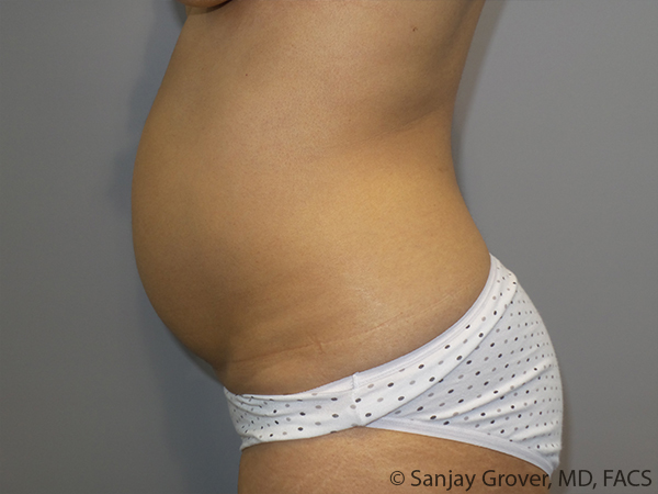 Tummy Tuck Before and After 103 | Sanjay Grover MD FACS