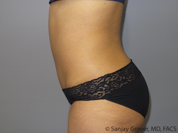 Tummy Tuck Before and After 103 | Sanjay Grover MD FACS