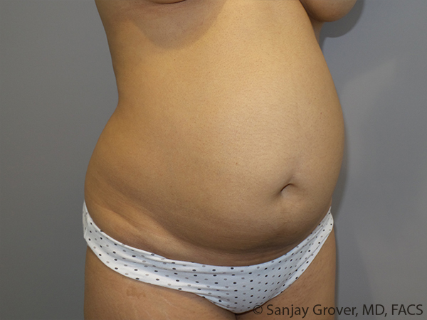 Tummy Tuck Before and After 103 | Sanjay Grover MD FACS