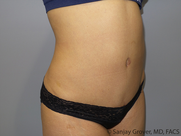 Tummy Tuck Before and After 103 | Sanjay Grover MD FACS