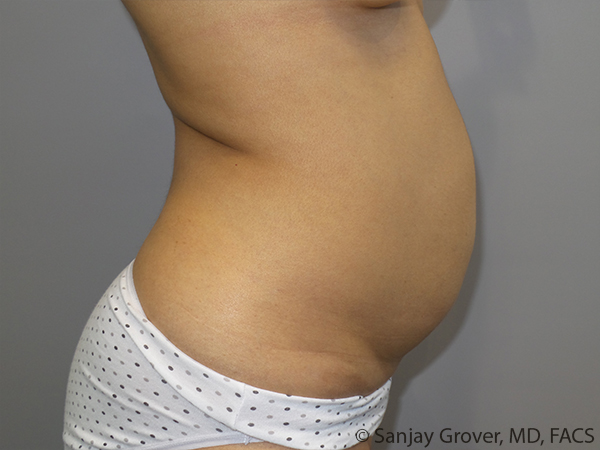 Tummy Tuck Before and After 103 | Grover Aesthetics