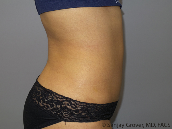 Tummy Tuck Before and After 103 | Sanjay Grover MD FACS