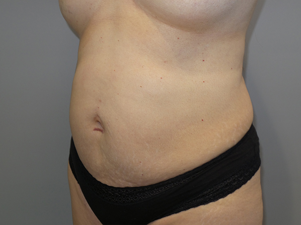 Tummy Tuck Before and After 104 | Sanjay Grover MD FACS