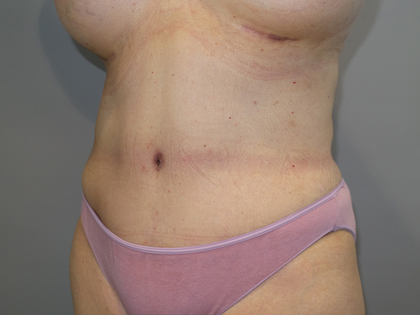 Tummy Tuck Before and After 104 | Sanjay Grover MD FACS