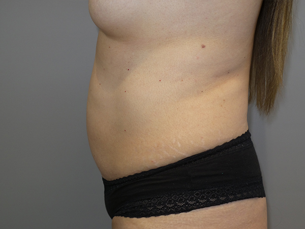 Tummy Tuck Before and After 104 | Sanjay Grover MD FACS