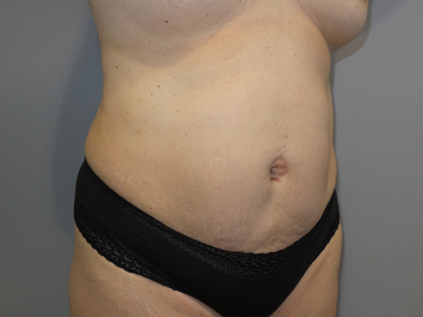 Tummy Tuck Before and After 104 | Sanjay Grover MD FACS