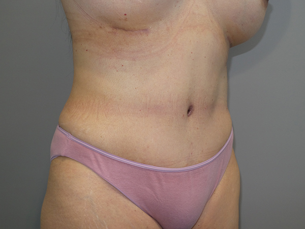 Tummy Tuck Before and After 104 | Sanjay Grover MD FACS