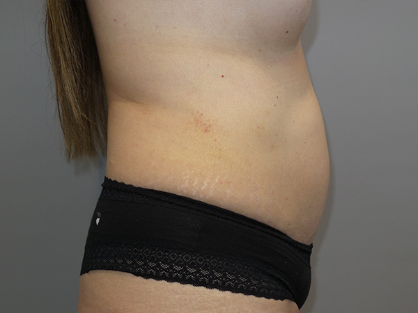 Tummy Tuck Before and After 104 | Sanjay Grover MD FACS