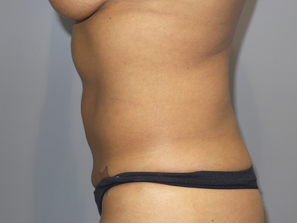 Tummy Tuck Before and After 105 | Sanjay Grover MD FACS