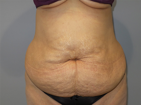 Tummy Tuck Before and After | Grover Aesthetics