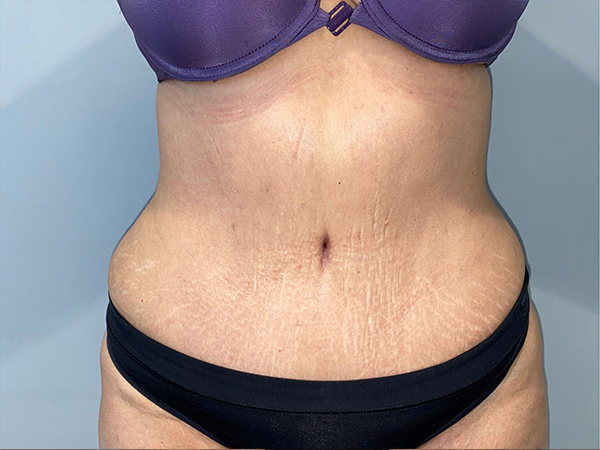 Tummy Tuck Before and After | Grover Aesthetics