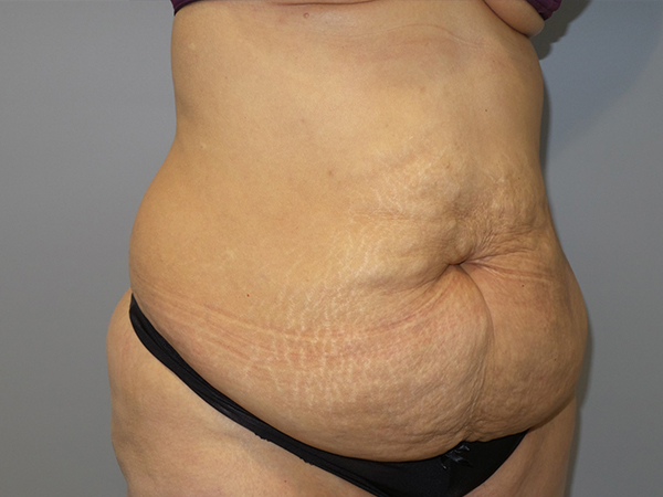 Tummy Tuck Before and After 106 | Sanjay Grover MD FACS