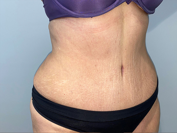 Tummy Tuck Before and After 106 | Sanjay Grover MD FACS