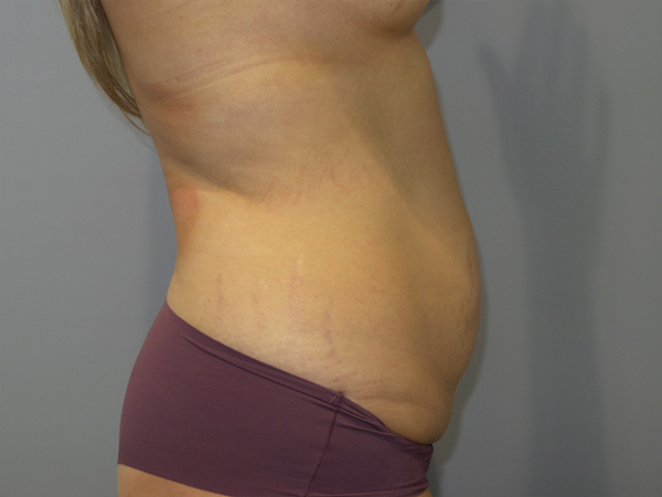 Tummy Tuck Before and After 106 | Sanjay Grover MD FACS