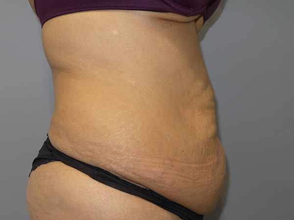 Tummy Tuck Before and After 106 | Sanjay Grover MD FACS