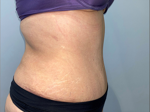 Tummy Tuck Before and After 106 | Sanjay Grover MD FACS