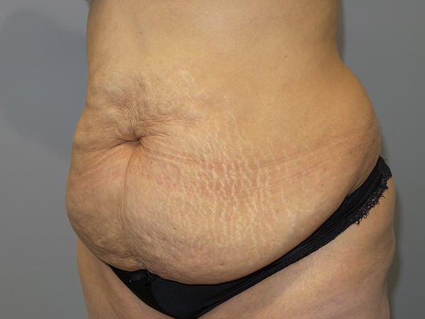 Tummy Tuck Before and After 106 | Sanjay Grover MD FACS