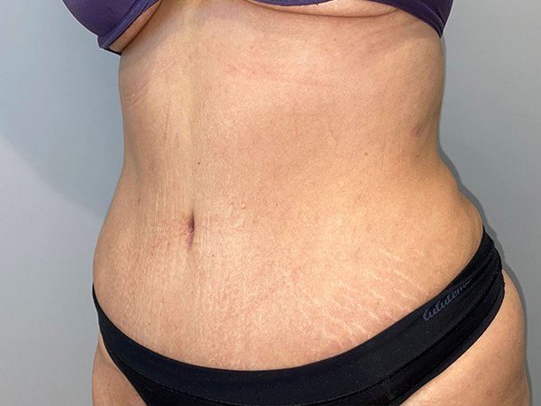 Tummy Tuck Before and After 106 | Sanjay Grover MD FACS