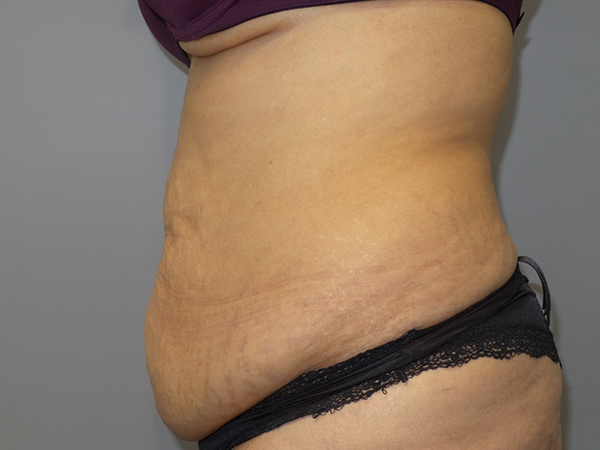 Tummy Tuck Before and After 106 | Sanjay Grover MD FACS