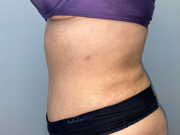 Tummy Tuck Before and After 106 | Sanjay Grover MD FACS