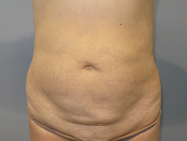 Tummy Tuck Before and After 17 | Sanjay Grover MD FACS