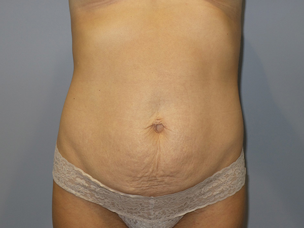 Tummy Tuck Before and After 09 | Sanjay Grover MD FACS