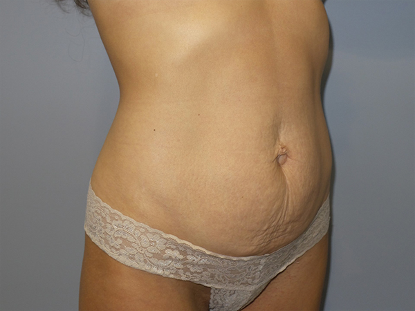 Tummy Tuck Before and After 107 | Sanjay Grover MD FACS