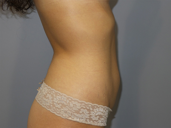 Tummy Tuck Before and After 107 | Grover Aesthetics