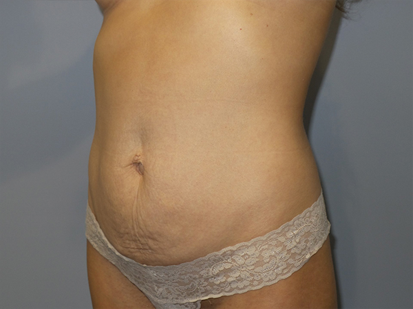 Tummy Tuck Before and After 107 | Sanjay Grover MD FACS