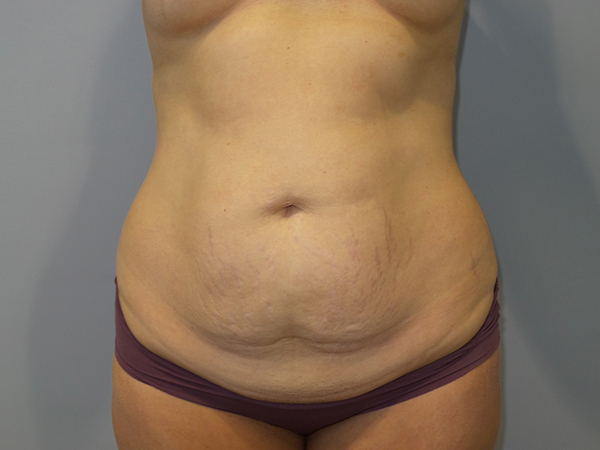 Tummy Tuck Before and After | Grover Aesthetics
