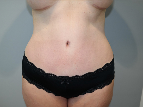 Tummy Tuck Before and After | Grover Aesthetics