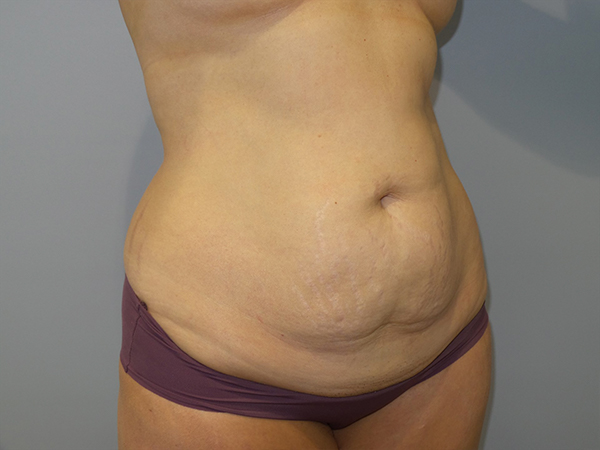 Tummy Tuck Before and After 108 | Sanjay Grover MD FACS