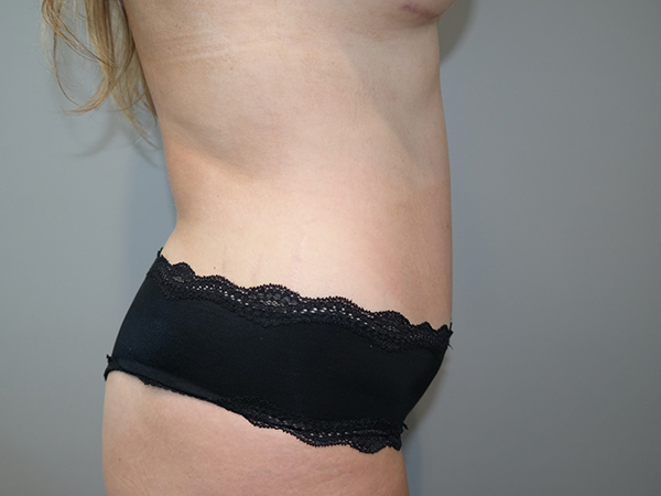 Tummy Tuck Before and After 108 | Sanjay Grover MD FACS