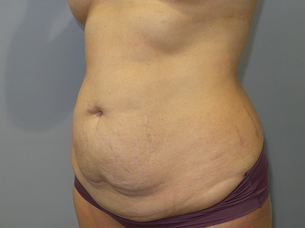 Tummy Tuck Before and After 108 | Sanjay Grover MD FACS