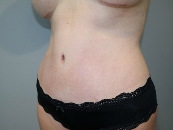 Tummy Tuck Before and After 108 | Sanjay Grover MD FACS